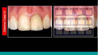 Anterior Composite Webinar amp Demonstration [upl. by Ariec]