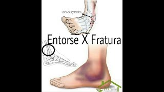 Entorse do Tornozelo com Fratura Luxação TRATAMENTO CONSERVADOR Clínica Fisioterapia Dr Robson Sitta [upl. by Eycal409]