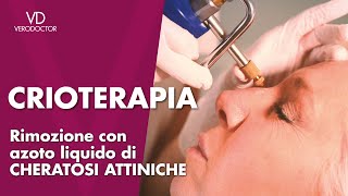 Crioterapia rimozione con azoto liquido di cheratosi attiniche [upl. by Leizo]