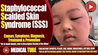 Staphylococcal Scalded Skin Syndrome SSS  Causes Symptoms Treatment  Lancet Infectious Diseases [upl. by Aicirt361]