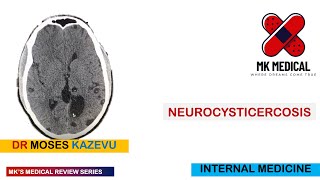 Neurocysticercosis [upl. by Esital]