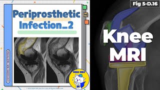 Fig 5D16 Periprosthetic Infection  Synovitis [upl. by Meehyr]