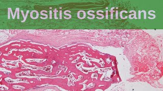 Myositis Ossificans  Pathology mini tutorials [upl. by Etnahs]