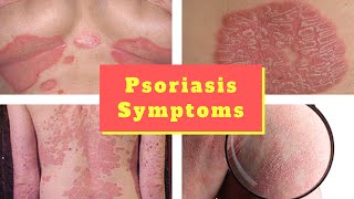 Psoriasis Pictures HD  Signs Symptoms Images Photos and Pictures of Psoriasis  Scalp Body [upl. by Barbara-Anne]