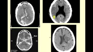 Stroke Syndromes  CRASH Medical Review Series [upl. by Eiderf]