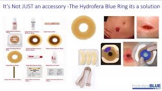 Ostomy Care with Hydrofera Blue Ostomy Ring [upl. by Dearden]