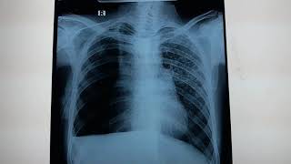 Hydropneumothorax on Chest Radiograph [upl. by Nitsirc]