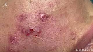 Big Cystic Acne Blackheads Extraction Blackheads amp Milia Whiteheads Removal Pimple Popping [upl. by Ennybor17]