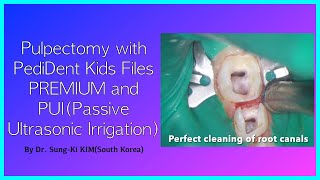 Pulpectomy with PediDent Kids Files PREMIUM and PUIPassive Ultrasonic Irrigation [upl. by Broddy]