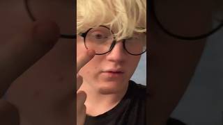 albeen albinismo albino albinism shorts youtubeshorts short viralvideo [upl. by Eldreda]