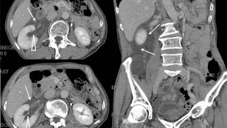 Moderate obstructive uropathy region due to renal calculus  cect abdomen and pelvis [upl. by Irv]