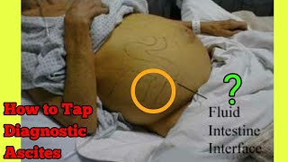 Ascitic tapping Procedure steps Ascites tapping complication  Ascites diagnostic tests [upl. by Formenti]