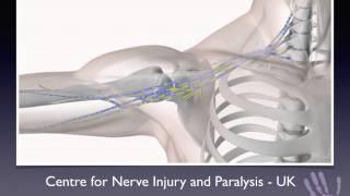 1 minute masterclass Nerve transfers for midcervical tetraplegia [upl. by Aurthur53]