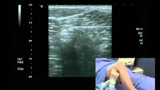 Popliteal Block Ultrasound guided  lateral approach [upl. by Ynalem]