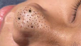 Big Cystic Acne Blackheads Extraction Blackheads amp Milia Whiteheads Removal Pimple Popping  396 [upl. by Rother358]