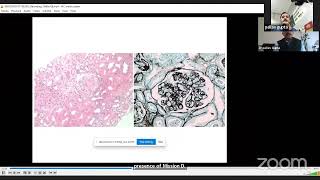 TMAThrombotic Microangiopathy in Renal Allograft Dr Pallav Gupta Lec 7 [upl. by Adnowat]