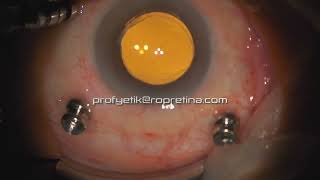 Vitreomacular Traction Vitrectomy Surgery [upl. by Lyret]