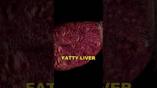 Understanding NAFLD NonAlcoholic Fatty Liver Disease Explained [upl. by Trebbor]