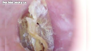 Ear Wax Removal 133 Thick Earwax Sticks To The Skin And Is Very Itchy  Ear Cleaning ASMR [upl. by Enailil562]