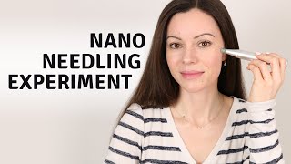 NanoNeedling for 3 Weeks with Deminuage amp the Ordinary Serum Before amp Afters [upl. by Eleon349]