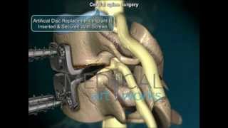 3D Medical Animation  Cervical spine artificial disc replacement and fusion comparison [upl. by Linnea]