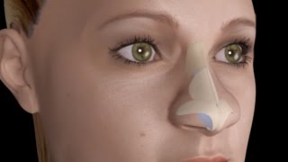 Bulbous Large Nasal Tip Nose Job Rhinoplasty [upl. by Noseaj632]