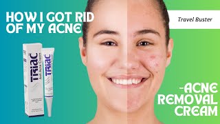 Triac Anti acne cream Review  Went from Acne Prone skin to Clear Skin  Honest Review [upl. by Vladamar]