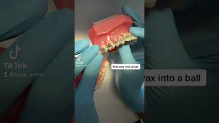 How to use orthodontic wax [upl. by Eirdua]