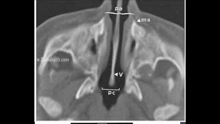 POSTERIOR CHOANAL ATRESIA VERSUS CONGENITAL APERTURE STENOSIS IN CT PNS OF TWO NEWBORN BABIES [upl. by Fidellia550]