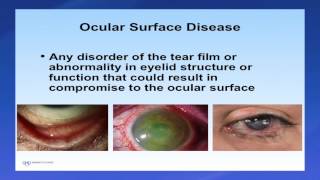 Introduction to Scleral Lenses [upl. by Tiloine]