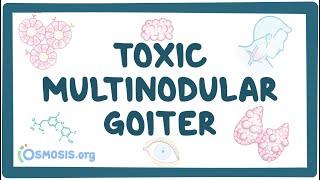 Toxic multinodular goiter  causes symptoms diagnosis treatment pathology [upl. by Steffi]