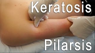 Keratosis Pilaris Clear  Brilliant Treatment FT Eric Smith  BLUSH Beverly Hills [upl. by Paxon]