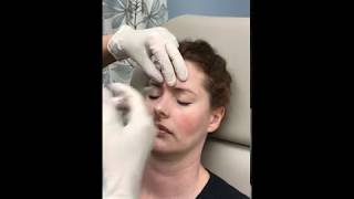 Botox to Glabella [upl. by Suicul]