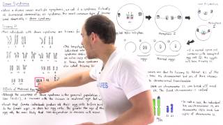 Down Syndrome Trisomy 21 and Translocation [upl. by Ahsinyd]