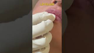 Lip Filler Treatment ✨ [upl. by Nattirb]