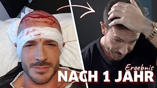 Ein Jahr nach meiner Haartransplantation  Ergebnis amp Fazit [upl. by Etterual]