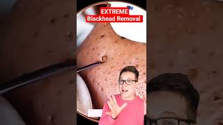 ⚠️ BIGGEST BLACKHEAD REMOVAL  Reaction shorts [upl. by Wyn660]