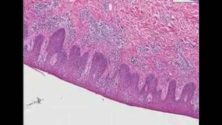 Histopathology SkinParapsoriasis [upl. by Eiffub345]