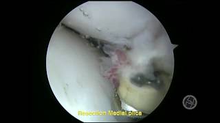 MEDIAL PLICA MY ARTHROSCOPIC TREATMENT Part 1 [upl. by Rox849]