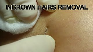 Ingrown Hairs Removal [upl. by Carleton]