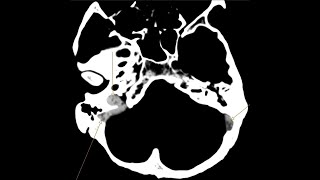 Venus Sinus Thrombosis and Intraventricular haemorrhage  CT CT angiogram and Venogram [upl. by Sherlock]