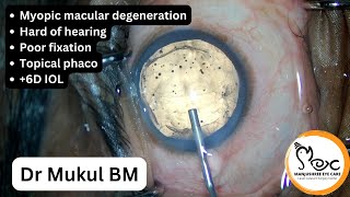 Myopic macular degen Topical phaco  6D IOL [upl. by Telfer823]