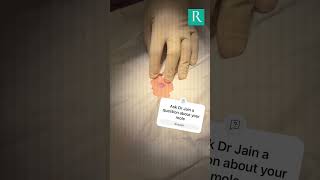 Witness the Mole Removal Process with Punch Biopsy [upl. by Idnew]