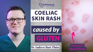 Dermatitis Herpetiformis Skin Rash Linked To Coeliac Disease Celiac And Gluten Intolerance [upl. by Atul]