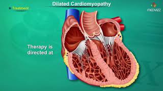 Dilated cardiomyopathy  DCM   Causes Signs and Symptoms Pathogenesis Diagnosis and Treatment [upl. by Karwan]