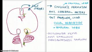 Easy Ways to Remember Cerebral Herniation [upl. by Joelle]