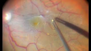 Epiretinal Membrane removal [upl. by Adhamh]