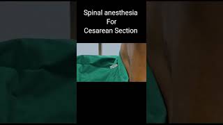 Spinal Anesthesia in Cesarean  OT stories  YouTubeShorts [upl. by Zachariah975]