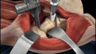 Direct Anterior Approach Hip Replacement [upl. by Eirroc449]