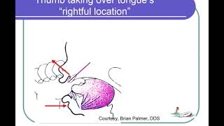 e190 Preview Orofacial MyologyTongue Thrust  An Introduction With Assessment Applications [upl. by Buke120]